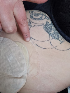 Warmer weather and an ostomy