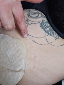 Warmer weather and an ostomy