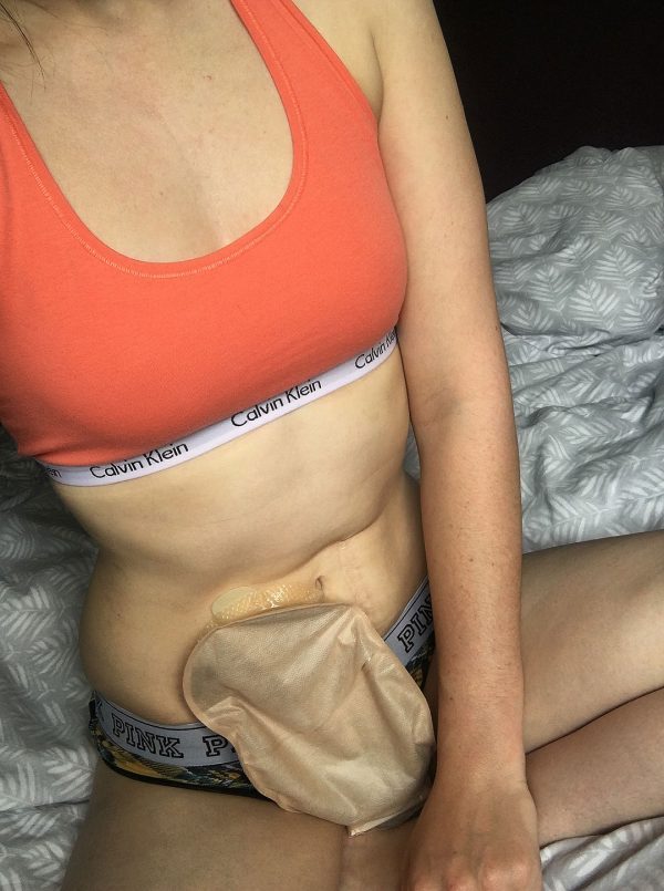 Stoma problems: Pancaking – the non-tempting kind!