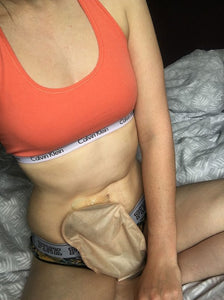 Stoma problems: Pancaking – the non-tempting kind!