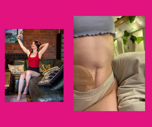 15 Stoma Facts for #WorldOstomyDay