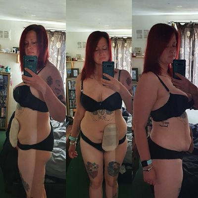 Weight loss and a stoma